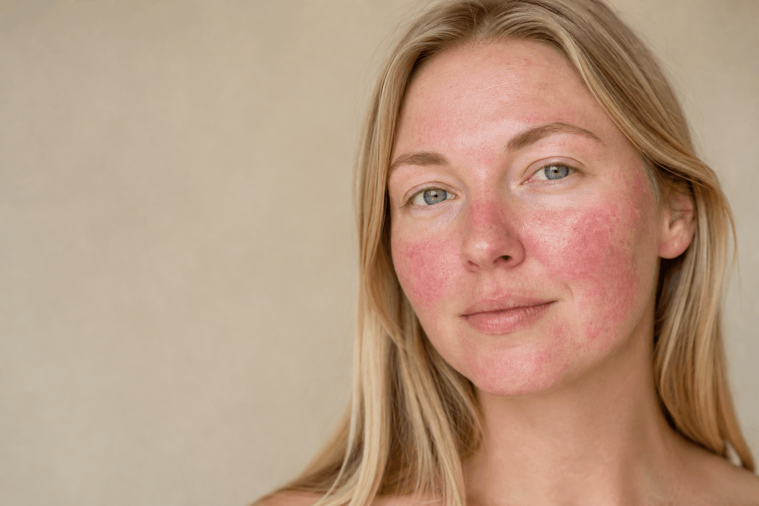 Best sunscreen for rosacea: how to choose SPF that does not sting - example skin