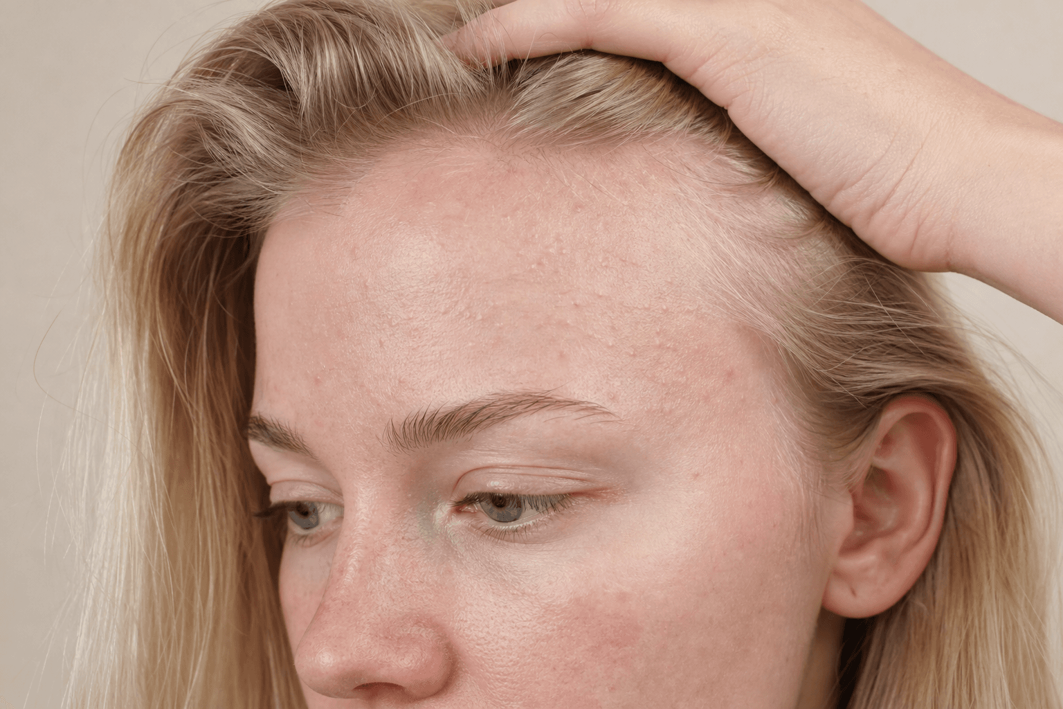 Fungal acne: why those tiny itchy bumps may not be acne - example skin