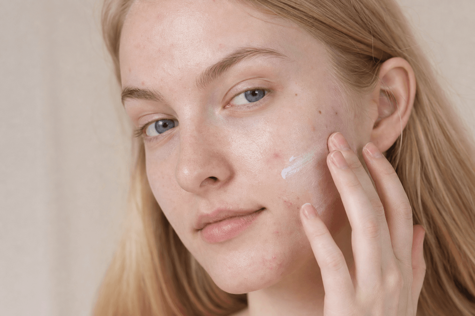Is mineral sunscreen better for acne-prone skin?