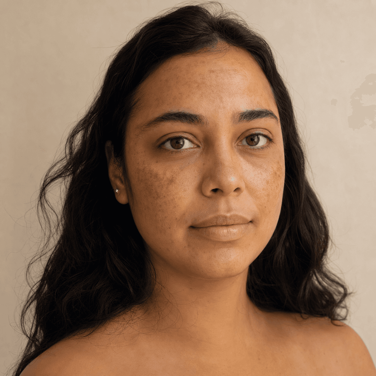 Melasma under graviditeten: vad som är säkert och vad som kan vänta