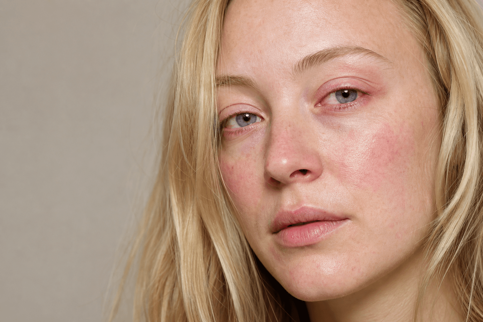 Ocular rosacea symptoms: eye signs you should not ignore - skincare guide
