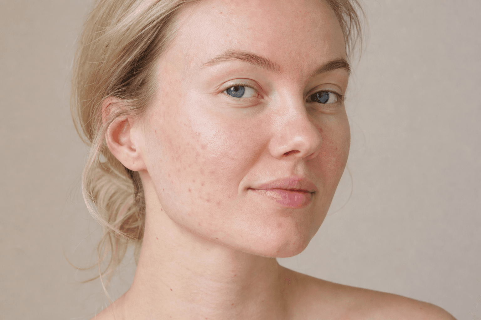 PIE vs PIH: red and brown acne marks explained simply - skincare guide