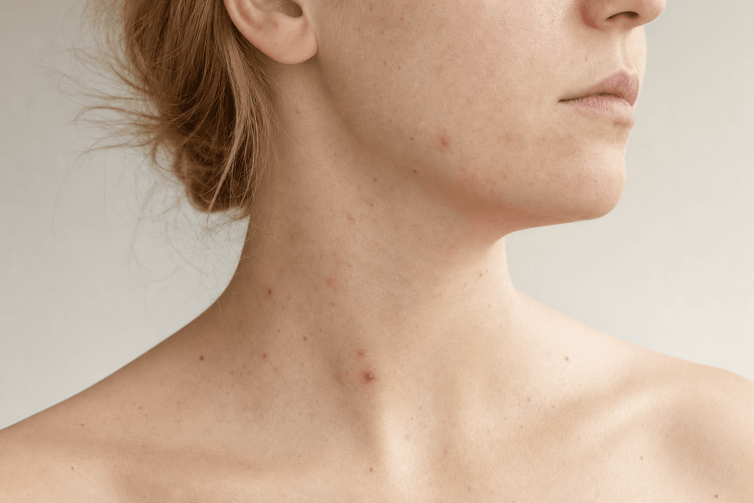 Why do I get pimples on my neck?
