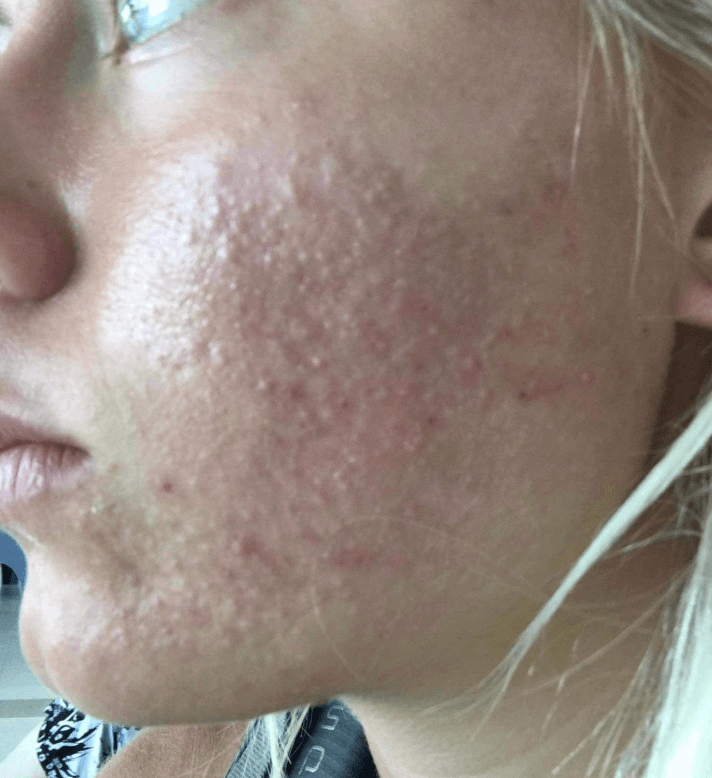 Amalie — before