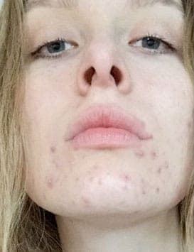 Signe — before