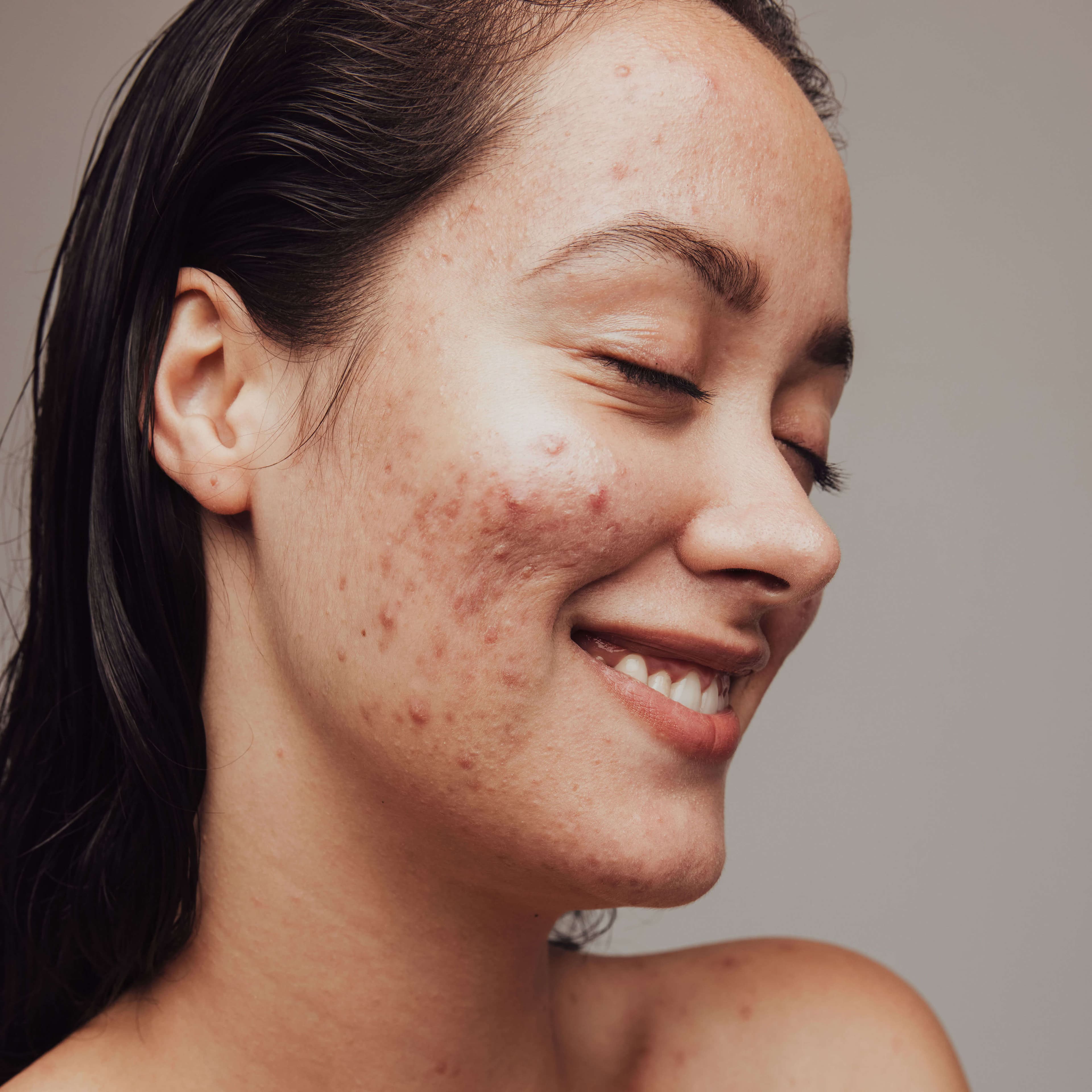 Acne and blemishes — skin example