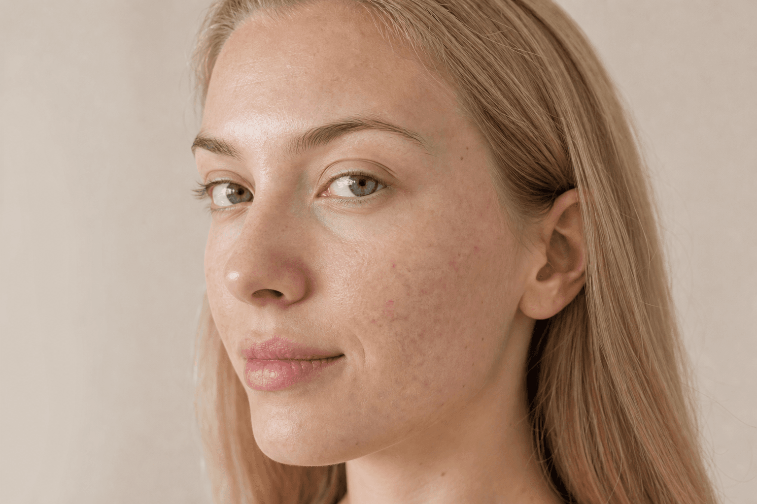 Acne scars: what actually helps after breakouts heal - example skin