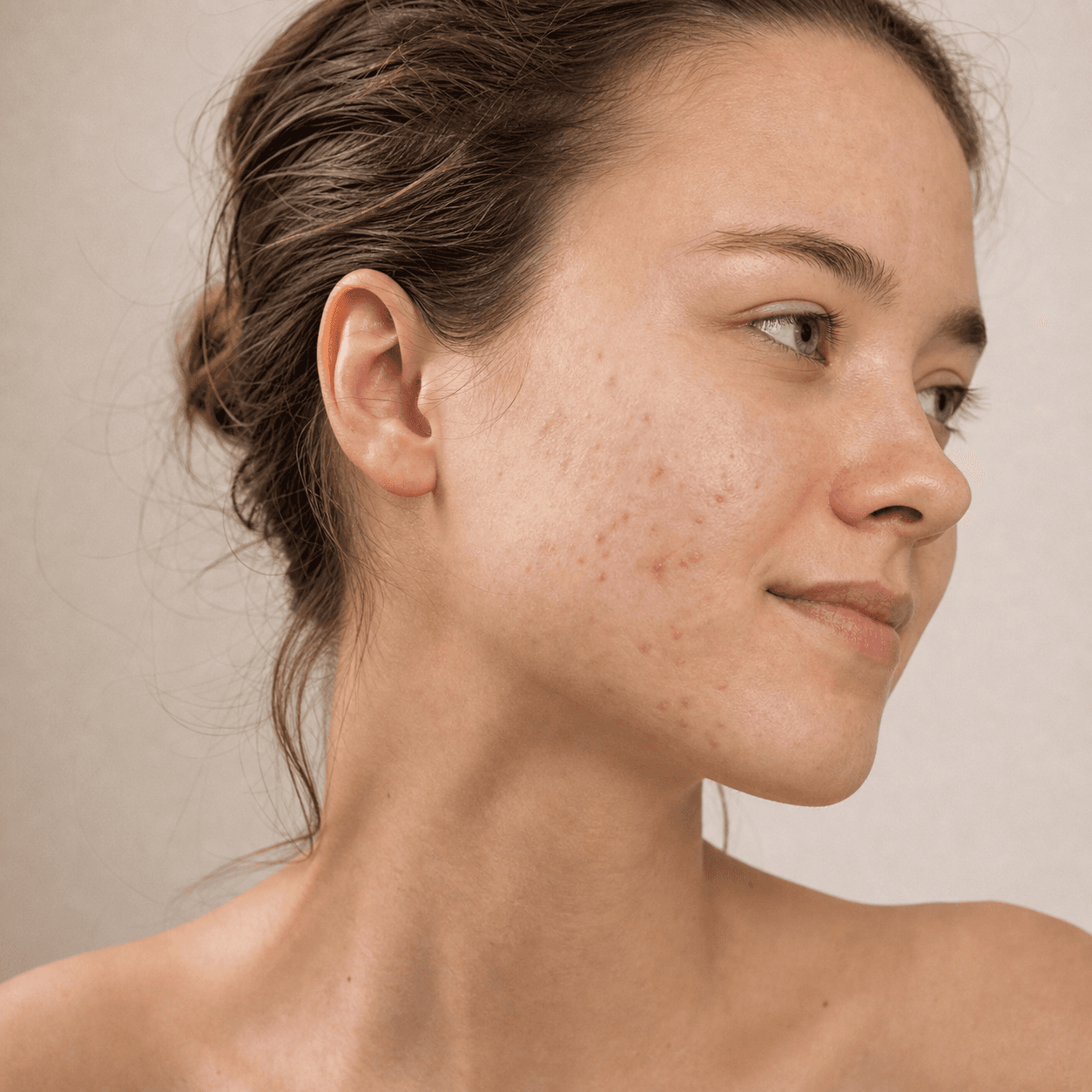 Aloe vera per l'acne: sostegno utile o rimedio sopravvalutato?