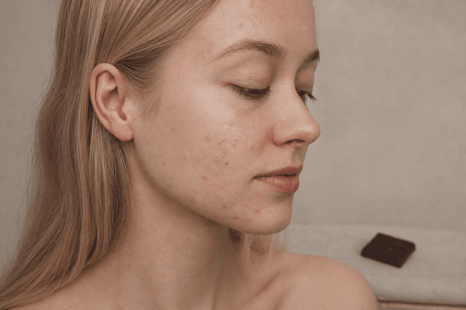 Chocolate and acne: is your favourite treat really breaking you out? - example skin