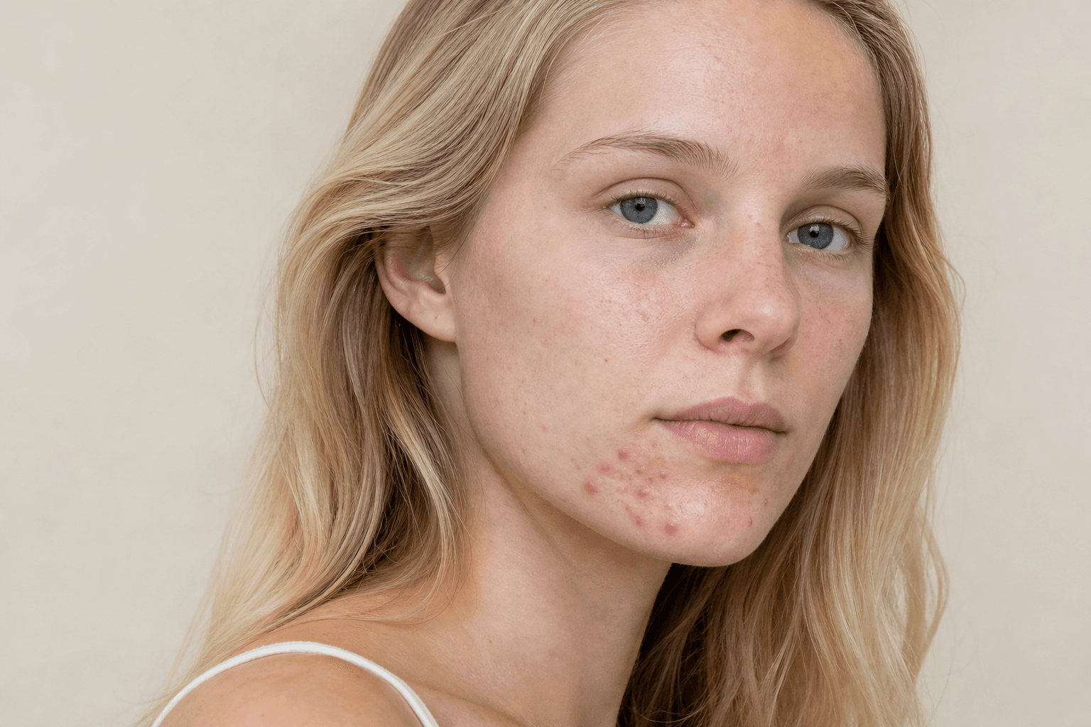 How to get rid of chin acne without declaring war on your face - example skin