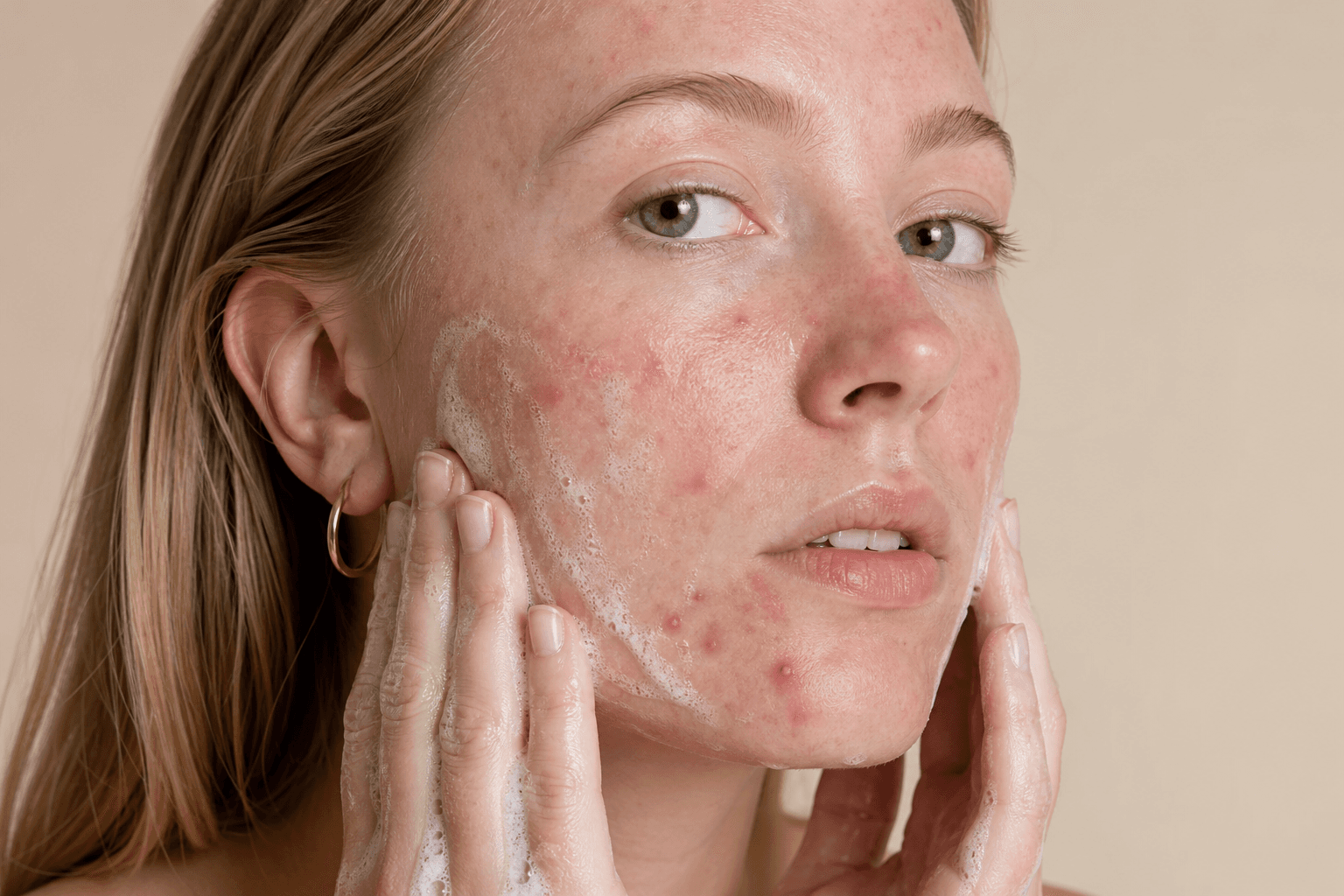 How to wash your face when you have acne