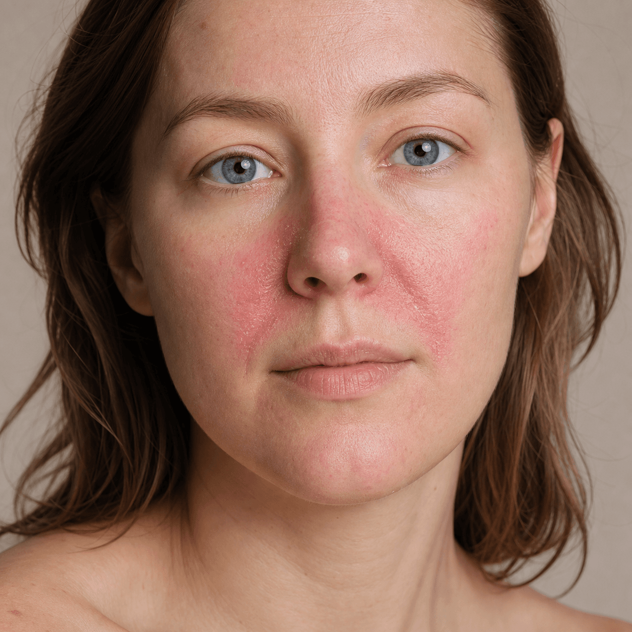 Redness around the nose: rosacea, dermatitis or irritation?