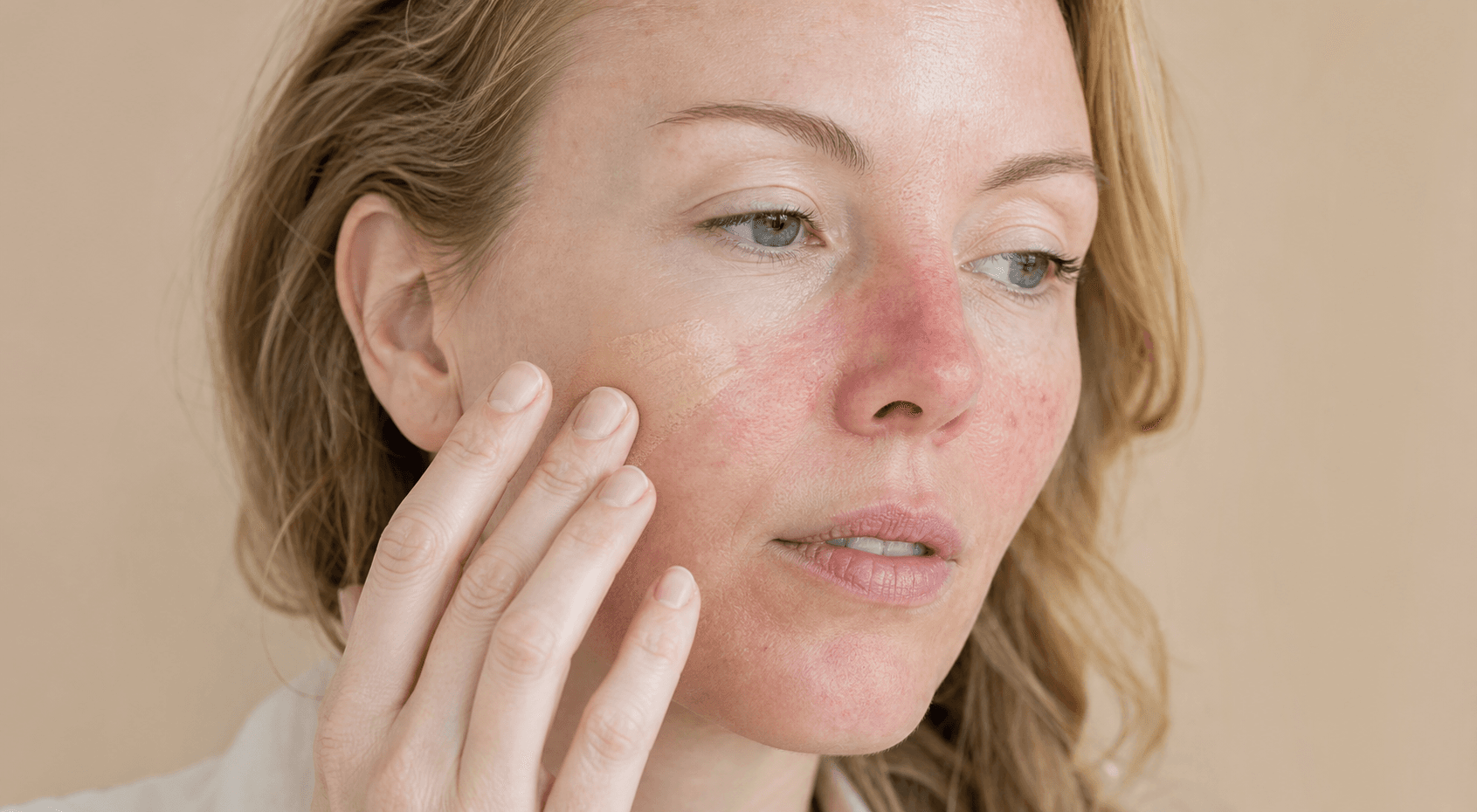 Rosacea e make-up: applicarlo e rimuoverlo con meno irritazione