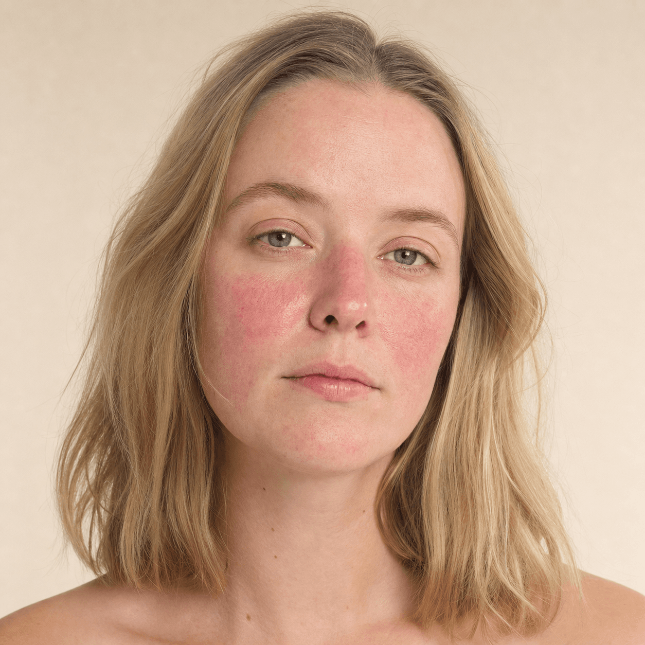 Rosacea e sonno: perché la stanchezza può aumentare il rossore