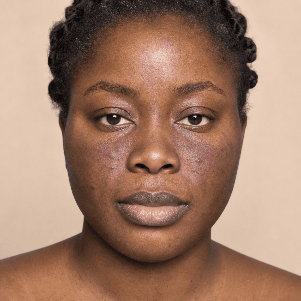 Rosacea i mörk hud: tecken som rodnad kan dölja
