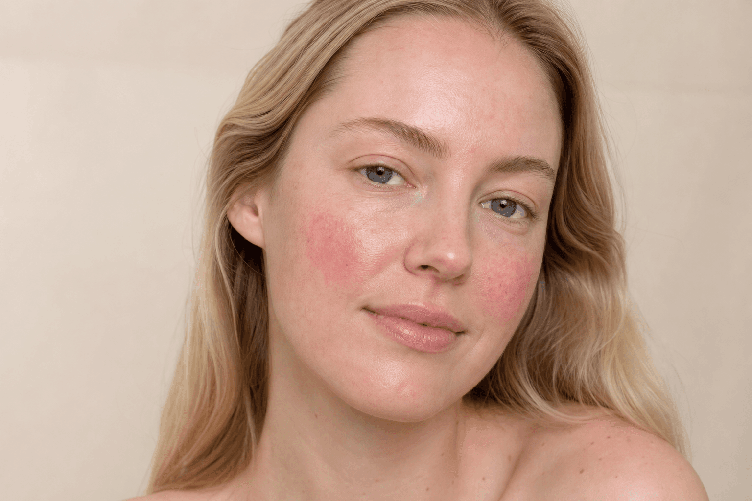 Best moisturizer for rosacea-prone skin: how to choose calmly - example skin