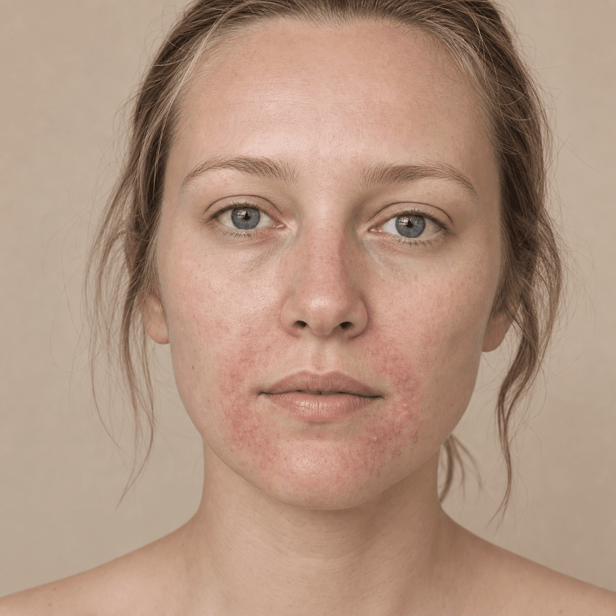 Steroidkräm och perioral dermatit: rekyl utan panik